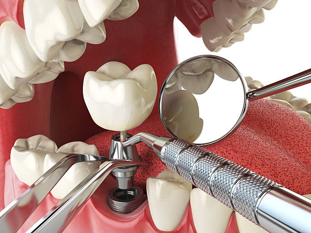 Best Broken or Cracked Tooth Emergency Dentist in Nes, IL